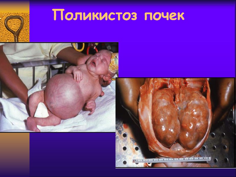 Поликистоз почек